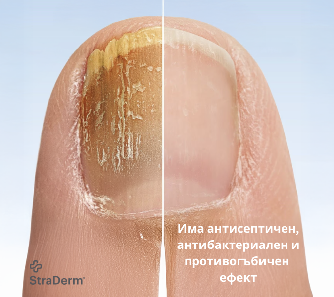 Активен разтвор за гъбички, екземи - 30мл